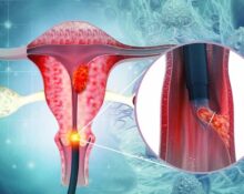 What is cervical cancer