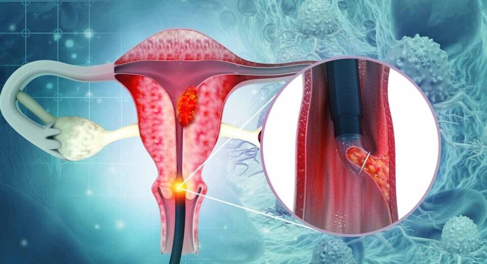 What is cervical cancer