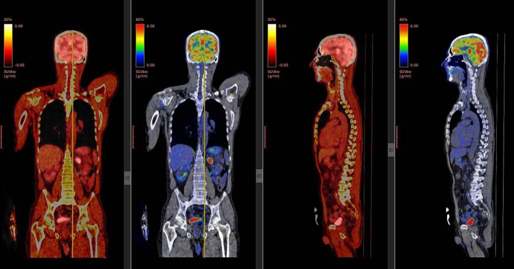 apa itu pet scan?