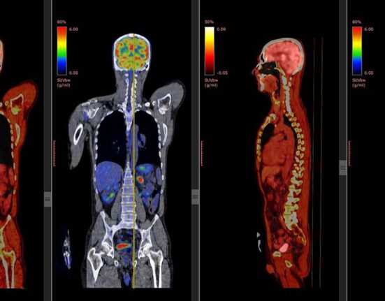 apa itu pet scan?