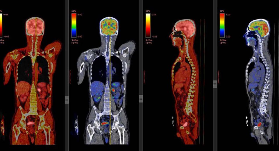 apa itu pet scan?