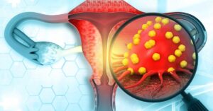 Ovarian Cancer Stages