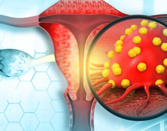 Ovarian Cancer Stages