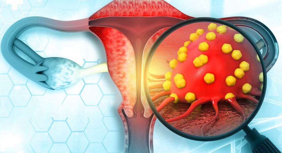 Ovarian Cancer Stages