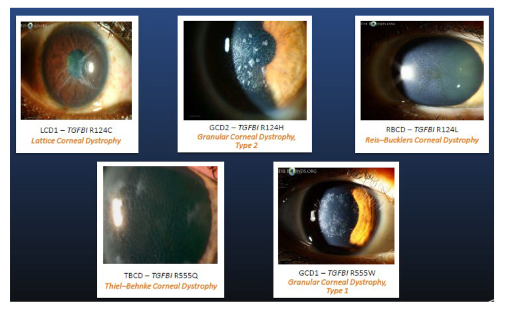 Understand Corneal Dystrophy