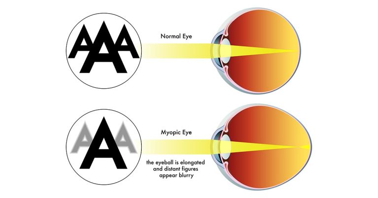 myopia illustration